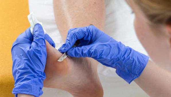 Pédicure-podologue enlevant les durillons d'un pied